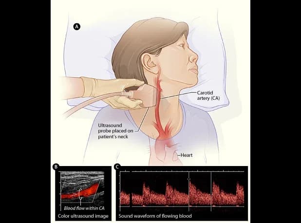 Medical illustration in three parts: an ultrasound probe held against the neck over the carotid artery, a colour Doppler ultrasound image with blood flow shown in colour, and a waveform of the flow speed against time.