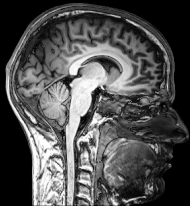 Structural MRI scan of a human head seen from the side, showing the folded cerebral cortex, the corpus callosum, the cerebellum at the back and the brainstem leading to the spinal cord.