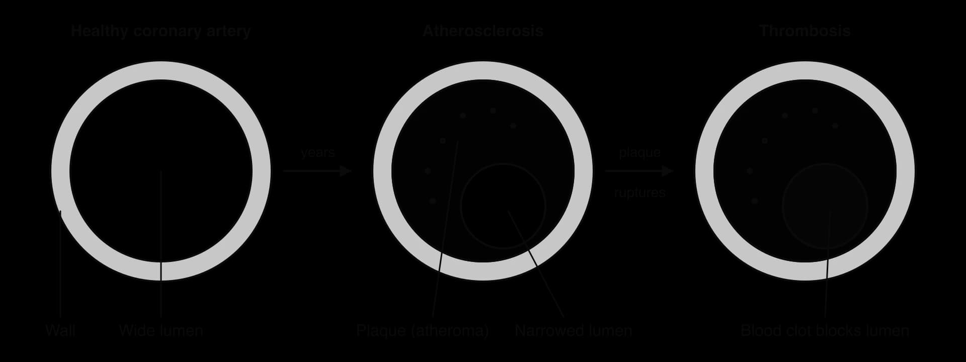 Three transverse sections of a coronary artery. A healthy artery with a wide lumen; an artery with a fatty plaque (atheroma) in the wall that narrows the lumen; and an artery in which the plaque has ruptured and a blood clot fills the remaining lumen.
