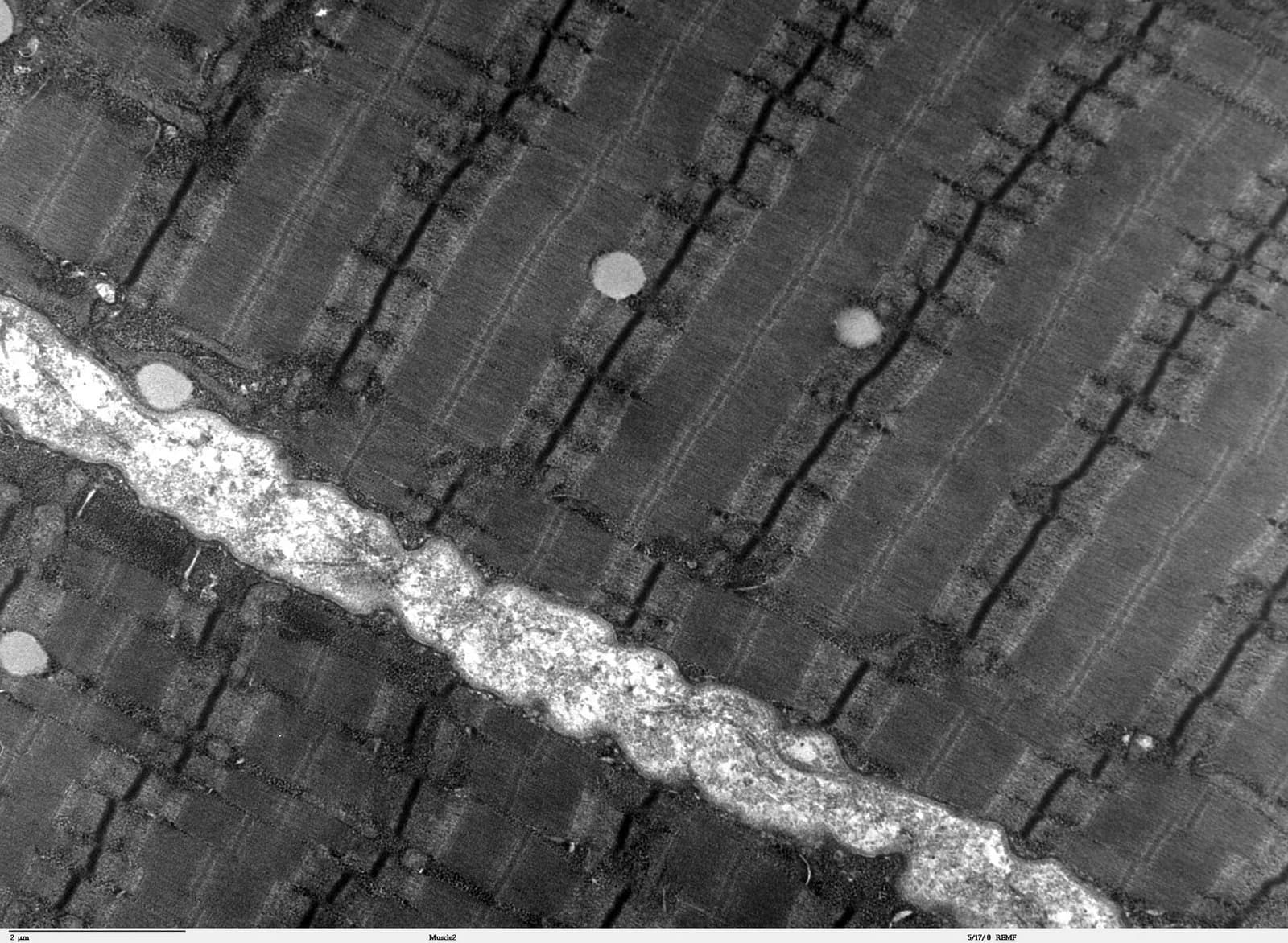 Transmission electron micrograph of human skeletal muscle in longitudinal section. Myofibrils run diagonally, crossed by regularly spaced dark Z-lines, with darker A bands and lighter I bands between them; a pale capillary runs across the lower left.