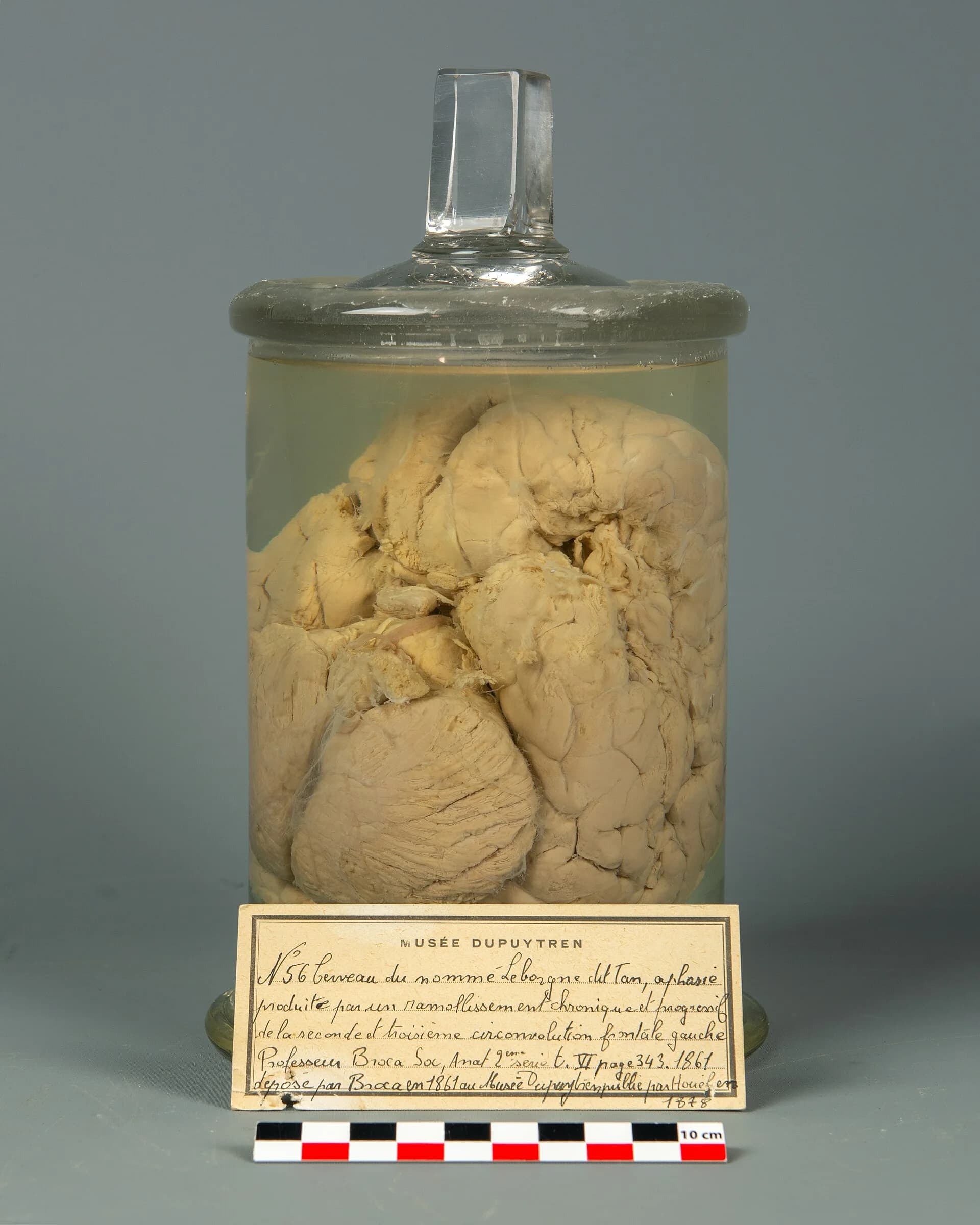 Leborgne's preserved brain in a glass jar at the Musée Dupuytren, Paris, with a handwritten museum label describing aphasia from softening of the left frontal convolutions, deposited by Broca in 1861.