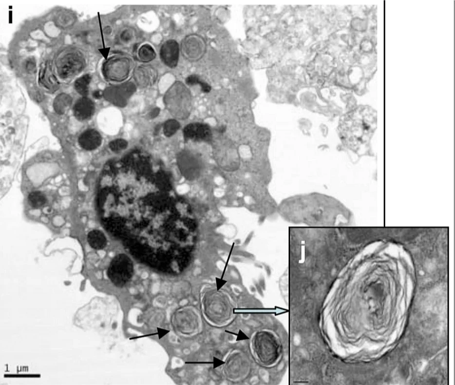 Transmission electron micrograph of a type II pneumocyte grown from human embryonic stem cells, with a dark nucleus and many round lamellar bodies made of concentric membrane layers, arrowed; an inset enlarges one lamellar body. Scale bar 1 µm.